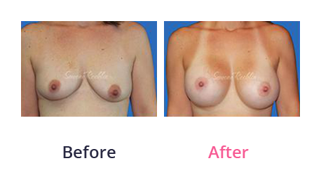 Mommy Makeover img (75)