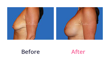 Mommy Makeover img (8)