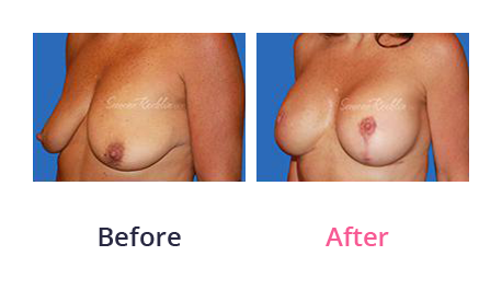 Mommy Makeover img (9)