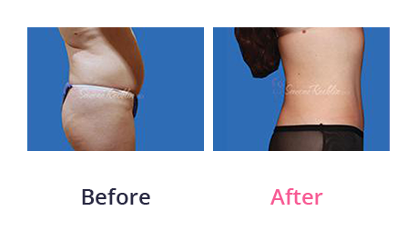 Tummy Tuck img (25)