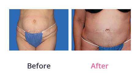 Tummy Tuck img (26)