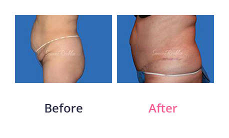 Tummy Tuck img (27)