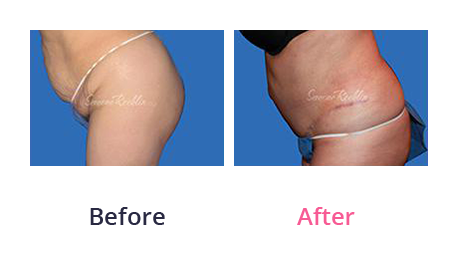 Tummy Tuck img (28)