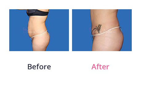 Tummy Tuck img (29)