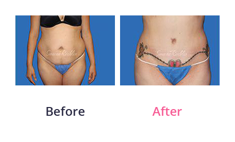 Tummy Tuck img (30)