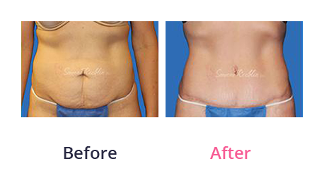 Tummy Tuck img (31)