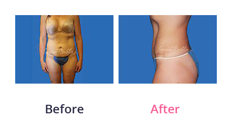 Tummy Tuck img (32)