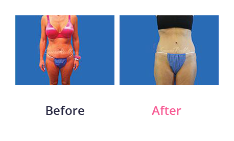 Tummy Tuck img (33)