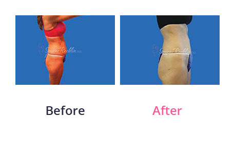 Tummy Tuck img (34)