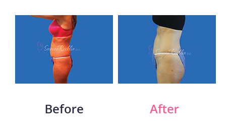 Tummy Tuck img (35)