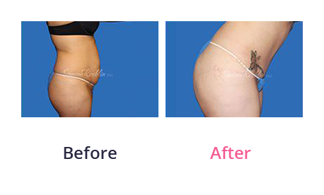 Tummy Tuck img (36)