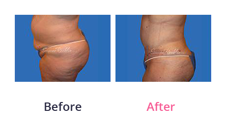 Tummy Tuck img (37)
