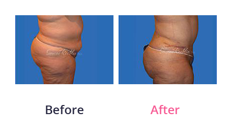 Tummy Tuck img (38)