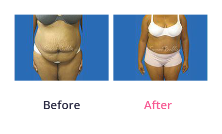 Tummy Tuck img (39)