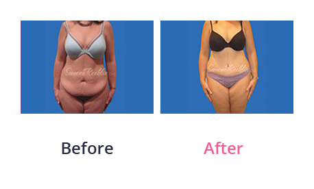 Tummy Tuck img (40)