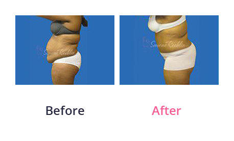 Tummy Tuck img (41)