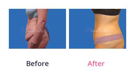 Tummy Tuck img (42)