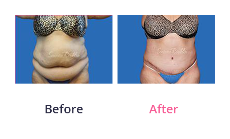 Tummy Tuck img (43)