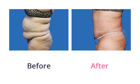 Tummy Tuck img (44)