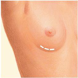 nipple incision under the breast