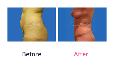 Mommy Makeover img (74)