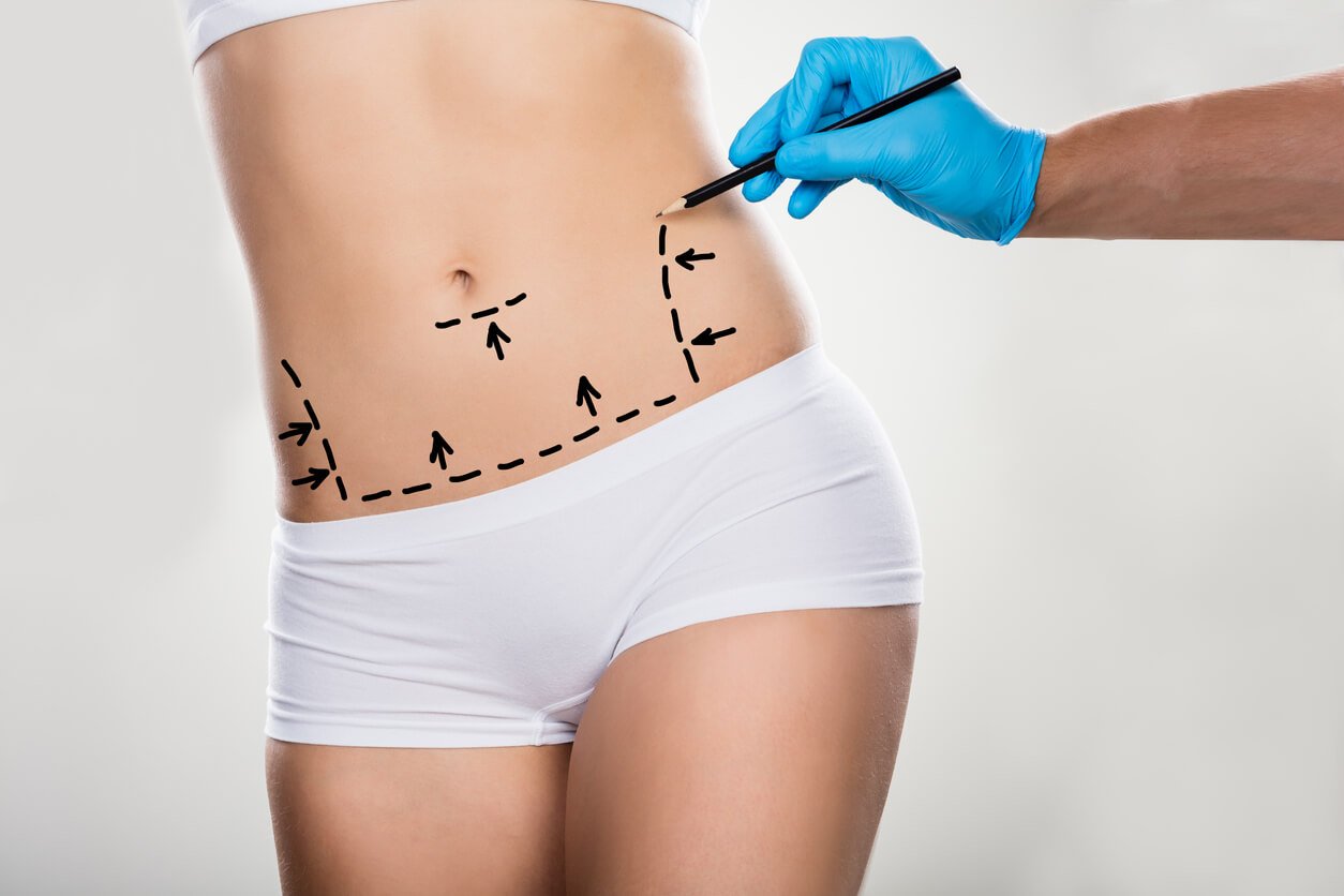 Surgeon Drawing Correction Lines On Woman's Stomach