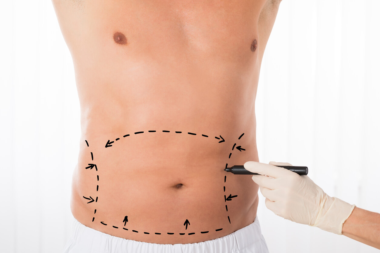 Person Hands Drawing Correction Lines On Stomach