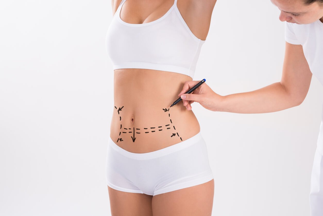 Surgeon Preparing Woman For Liposuction Surgery