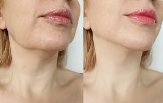 Chin Liposuction