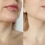 Chin Liposuction