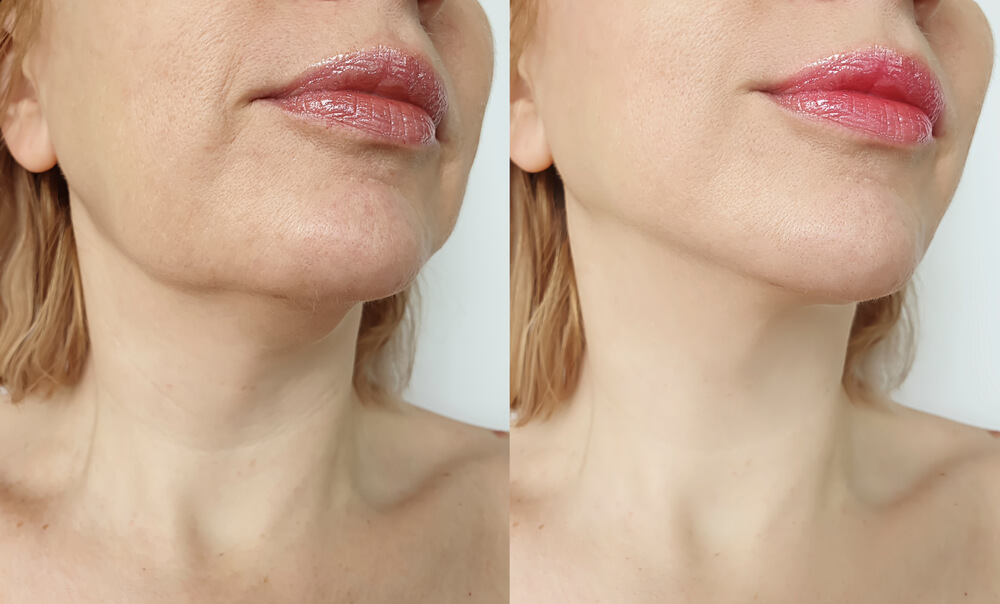 Chin Liposuction