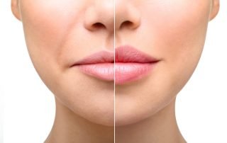 How to Reduce Swelling After Lip Injections and Fillers