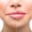 How to Reduce Swelling After Lip Injections and Fillers