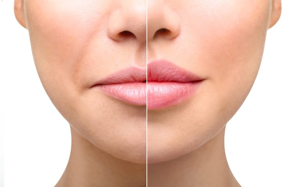 How to Reduce Swelling After Lip Injections and Fillers