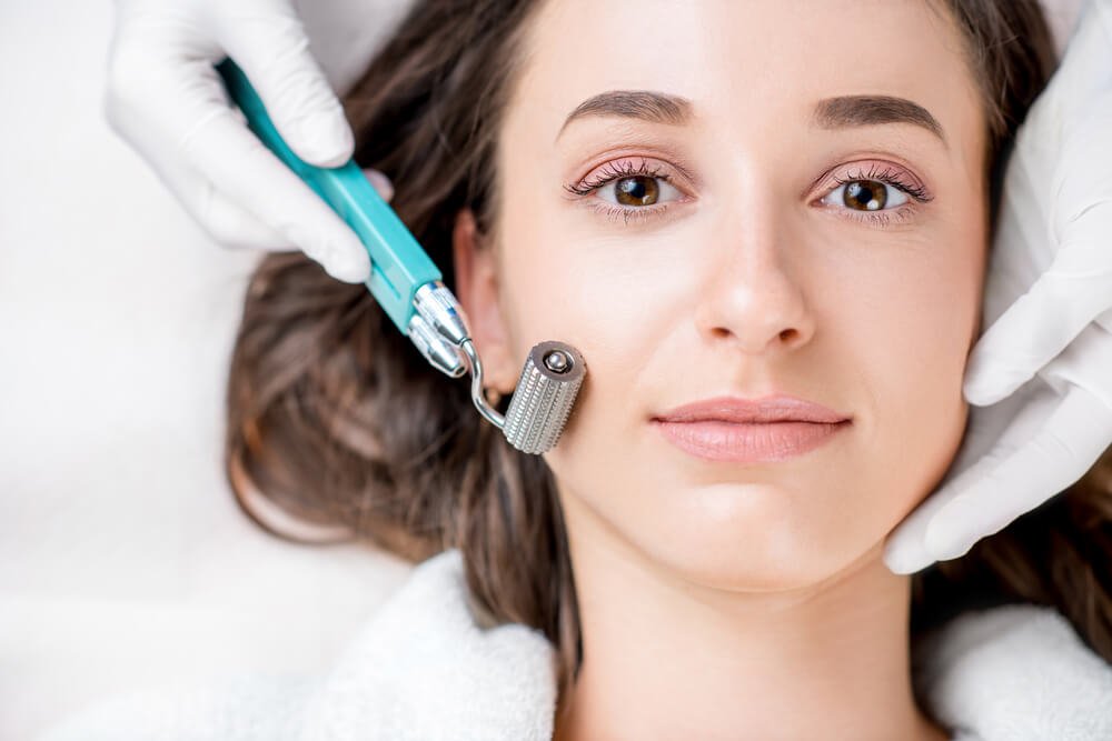 Does Microneedling for Acne Scars Work