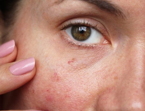 What Causes Spider Veins on the Face