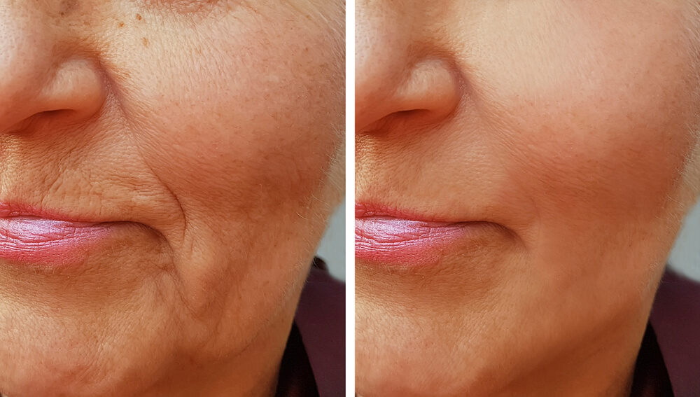 What Is Radiesse Best Used For