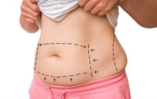 Surgical Lines On Woman's Body Before Plastic Surgery Operation