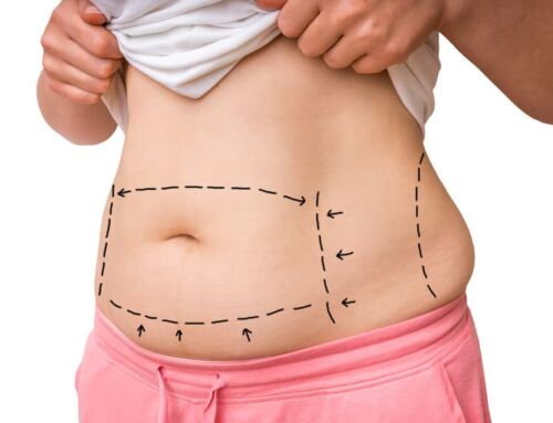 Things You Need to Know About the Mommy Makeover