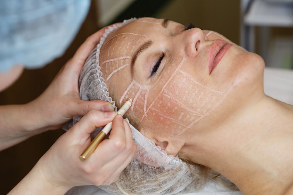 Non-Surgical Face Lifting.