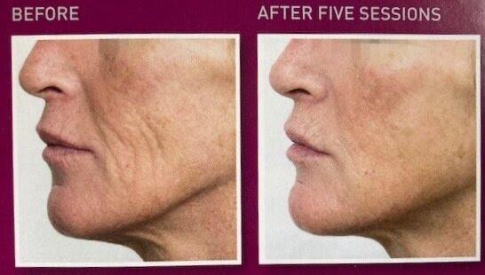 be7966f1-ce93-4f75-8a4d-64b5dc91240c Before and after PRX treatment