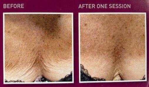 e724a25b-aa3d-45ab-99c0-7c310f31a35c Before and after PRX treatment
