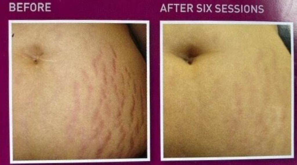 ec593037-d459-4b32-aeb0-32c4909f91d5 Before and after PRX treatment