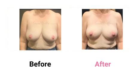 Mastopexy Without Implants