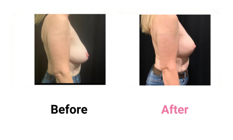 Mastopexy Without Implants