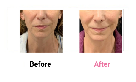 Lower Face & Neck Lift