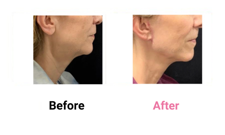 Lower Face & Neck Lift