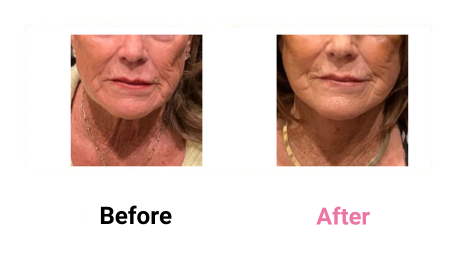 Short Scar Lower Neck & Face