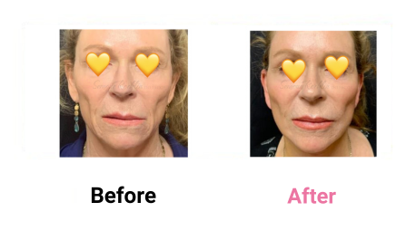 Short Scar Lower Neck & Face