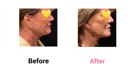 Short Scar Lower Neck & Face